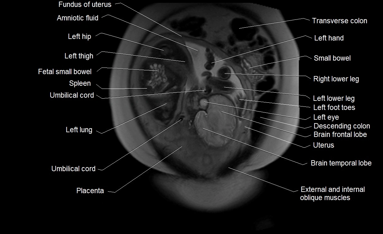 MRI Anatomy of pregnancy image 8.webp
